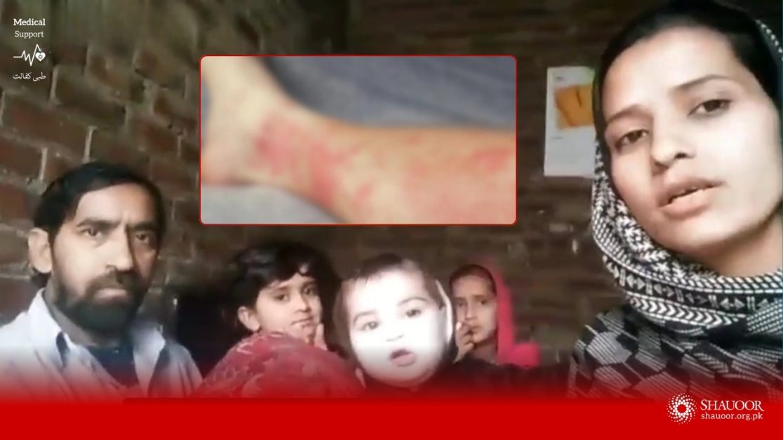 Bitten By a Poisonous Insect